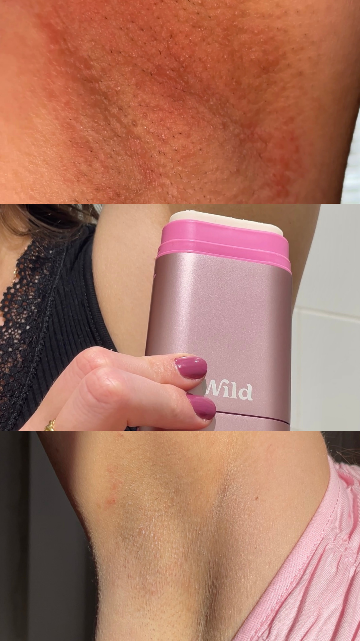 red irritated armpit skin caused by deodorant
