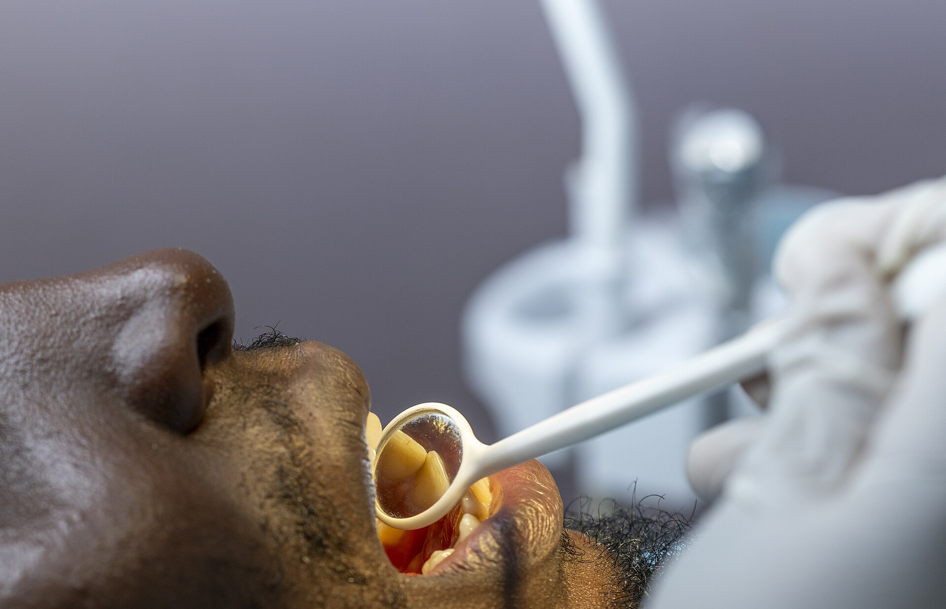 A dentist examining a patient's teeth with a dental mirror, the only legal route to peroxide above the limit set for teeth whitening kits in the UK