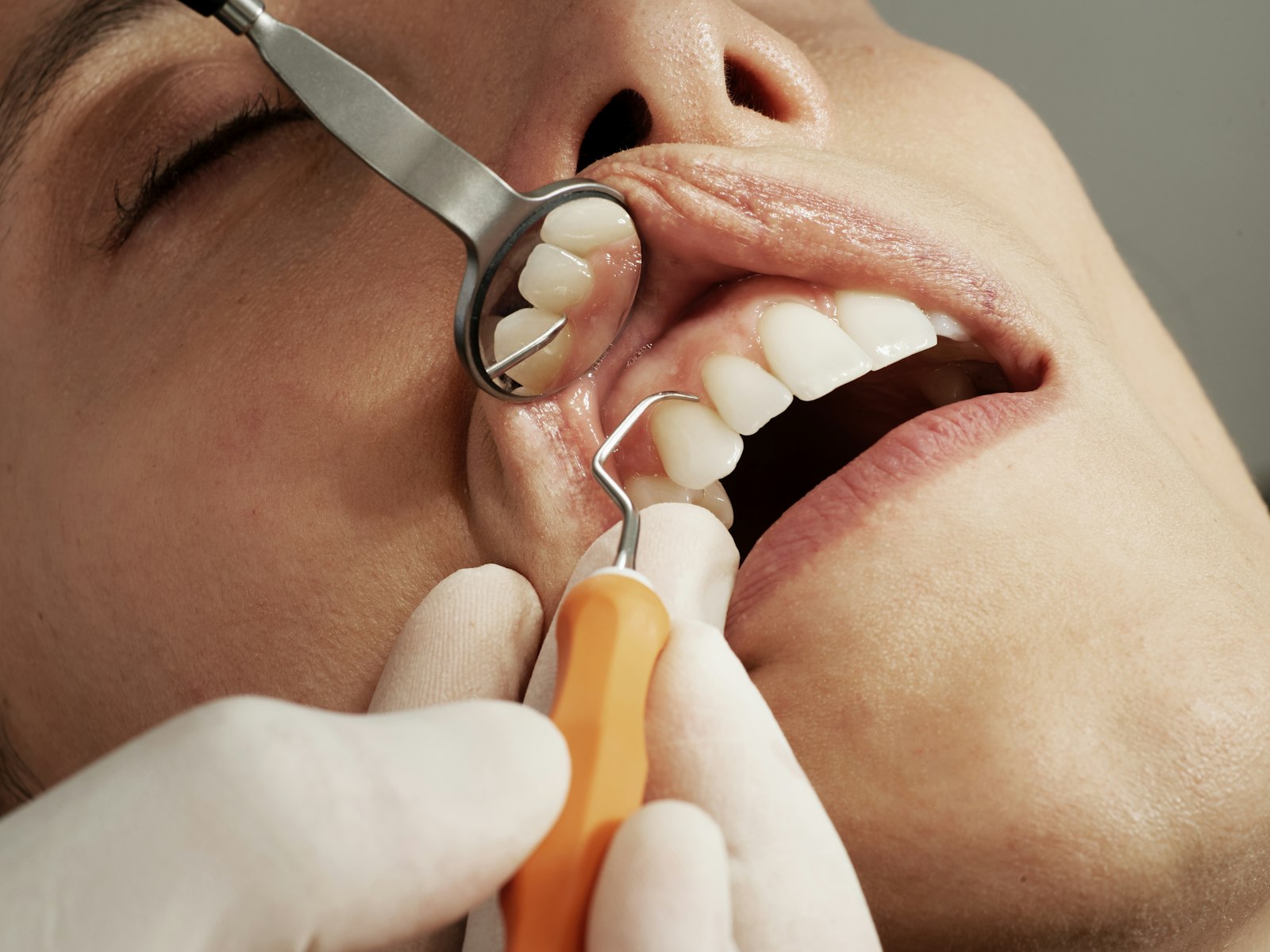 Dental examination with mirror and probe - dentists are checking for gum recession where nicotine pouches are habitually placed