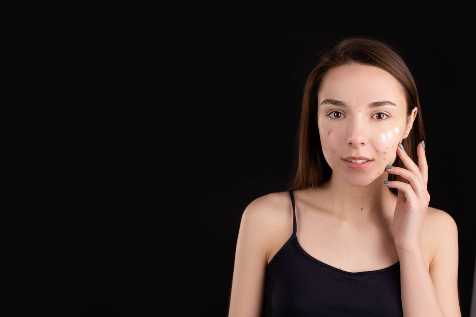 Teenager applying spot cream, the cheaper alternative to blue light from an LED face mask for mild acne
